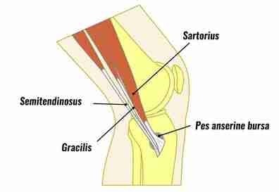 Labeled diagram of the inner knee showing the sartorius, gracilis, and semitendinosus tendons converging over the pes anserine bursa.