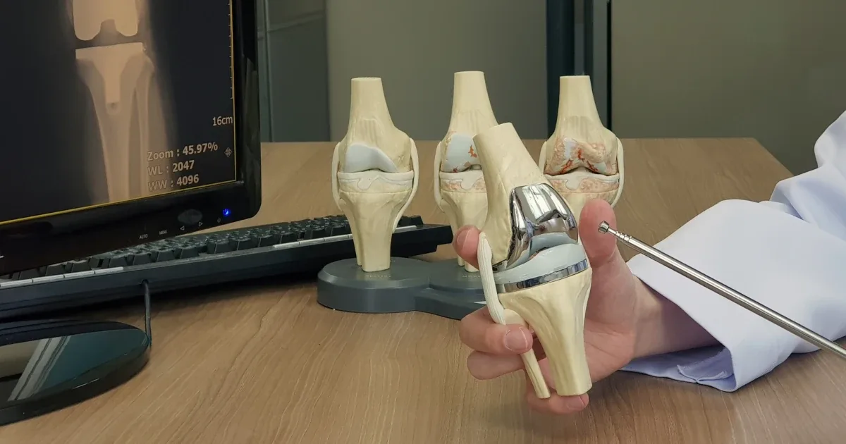 A clinician holds a total knee replacement model beside osteoarthritis-stage knee models and an X-ray on a monitor.