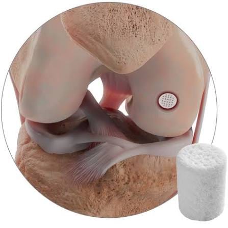 Illustration of the CartiHeal Agili-C cartilage implant placed in the femoral condyle of a knee, with the coral-based scaffold plug shown alongside.