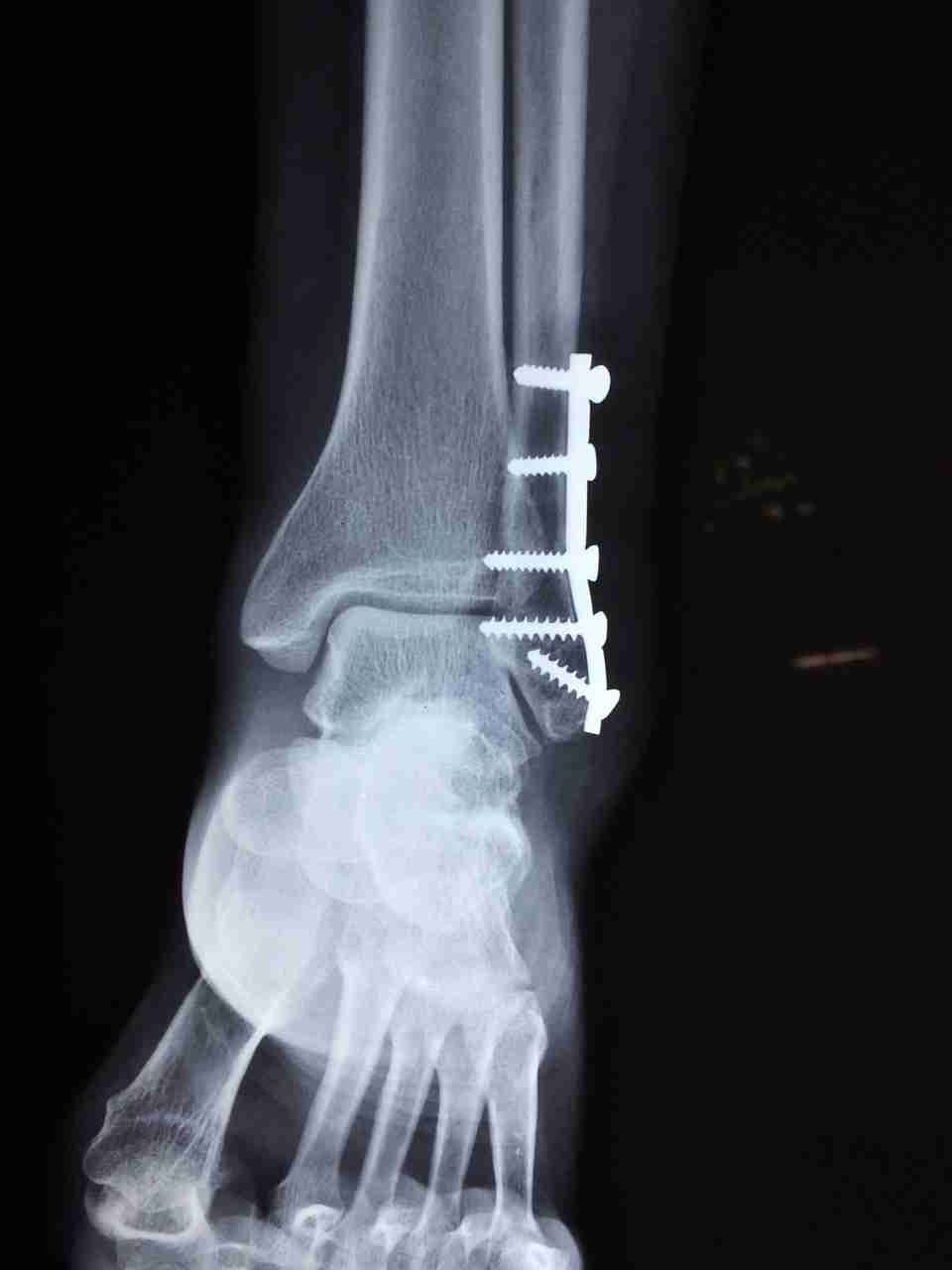 X-ray of an ankle fracture repaired with a metal fibular plate and screws.
