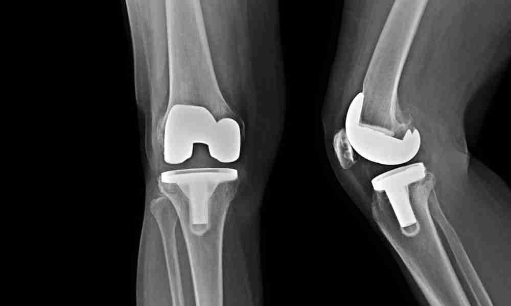 Front and side X-ray views of a knee after total knee replacement.