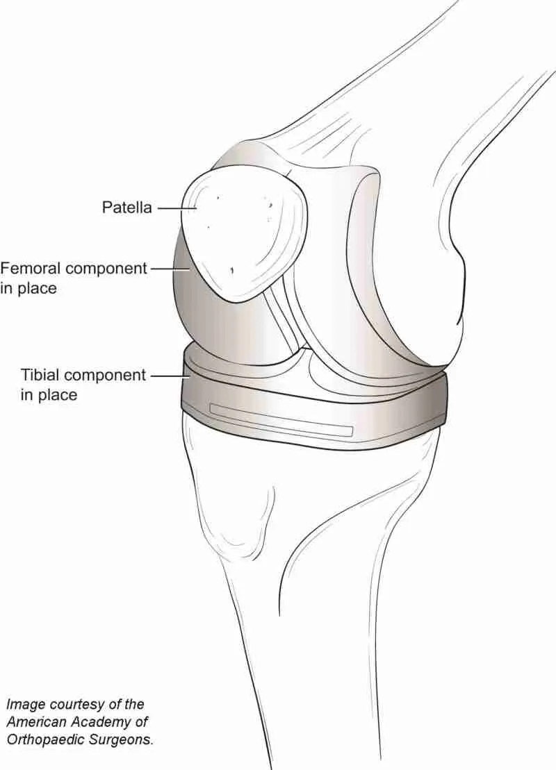 Is Metal Allergy A Concern In Hip And Knee Replacement Surgery? Dr