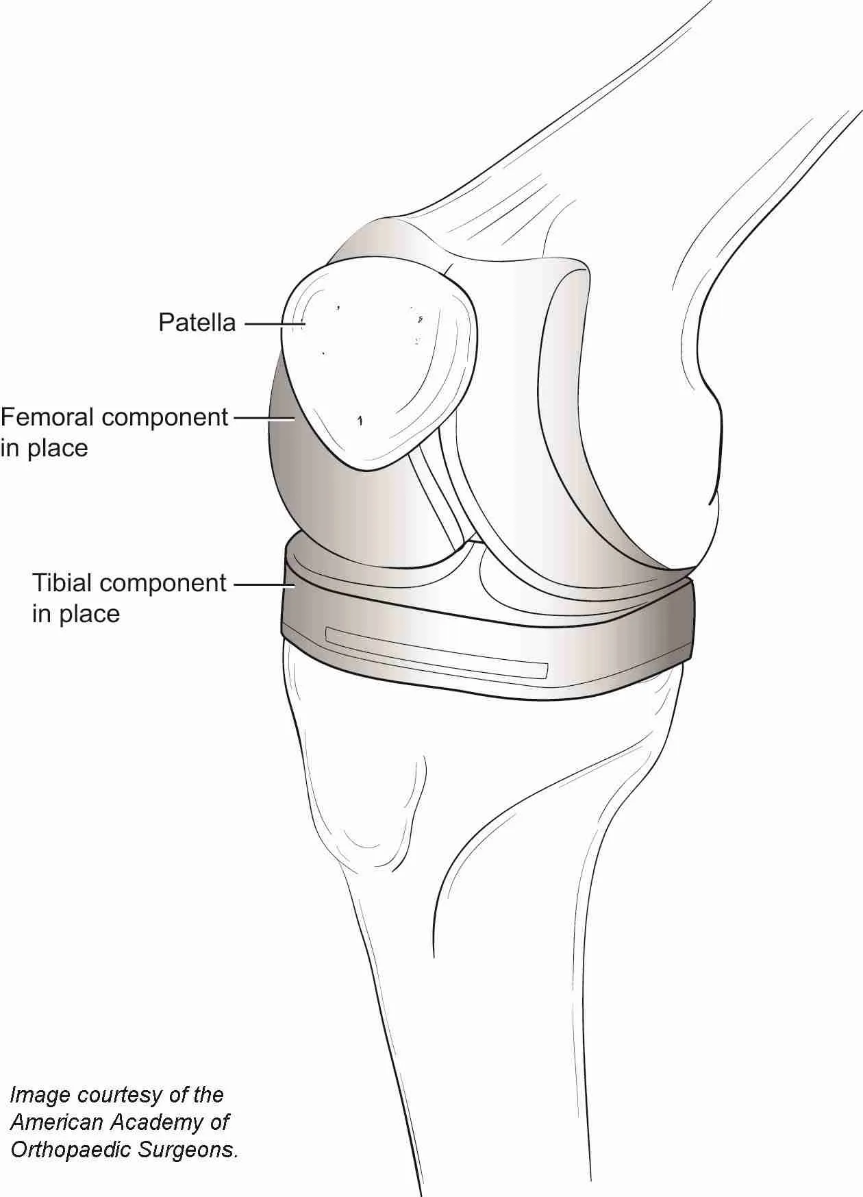 Total Knee Replacement total knee replacement