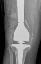 Revision Total Knee total knee replacement