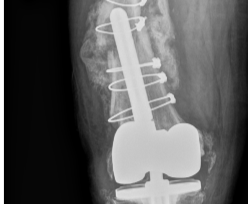 periprosthetic femur fracture periprosthetic femur fracture