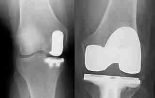 partial vs total knee replacement