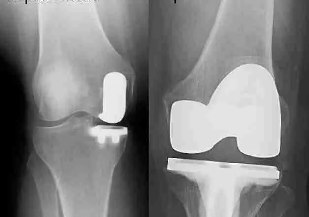 partial vs total knee replacement