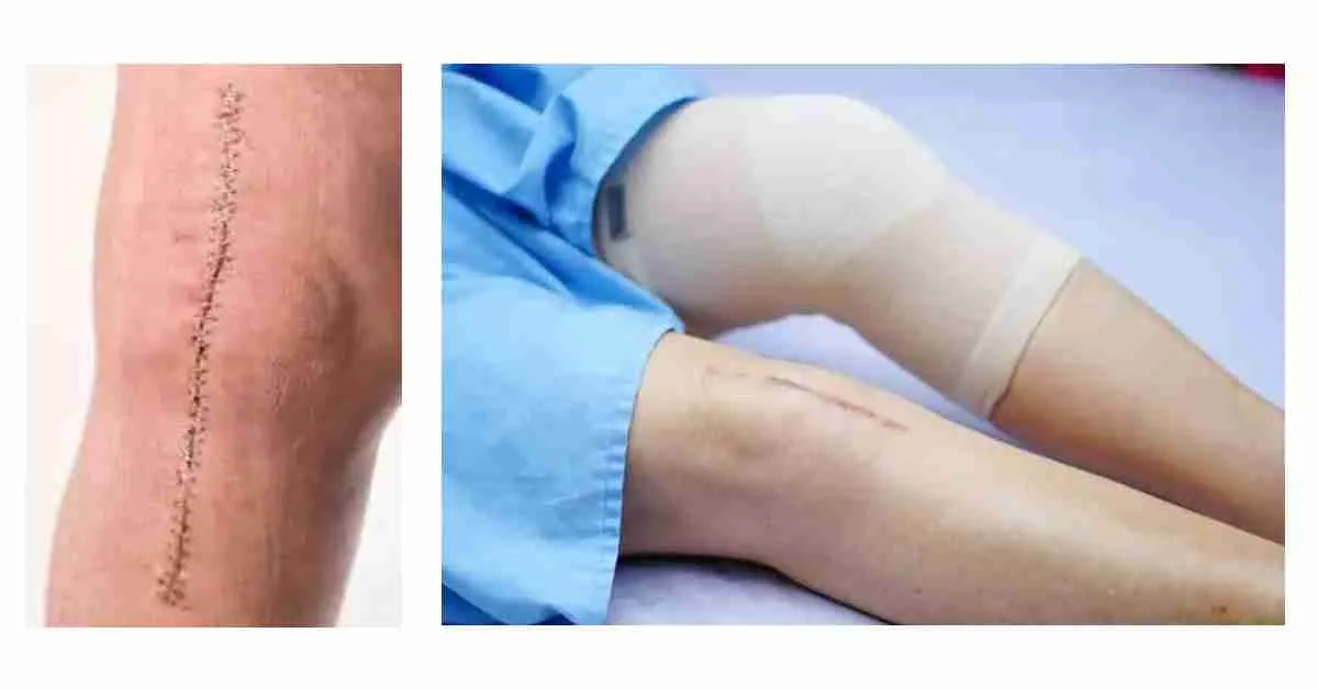 Wound management after Knee replacement surgery
