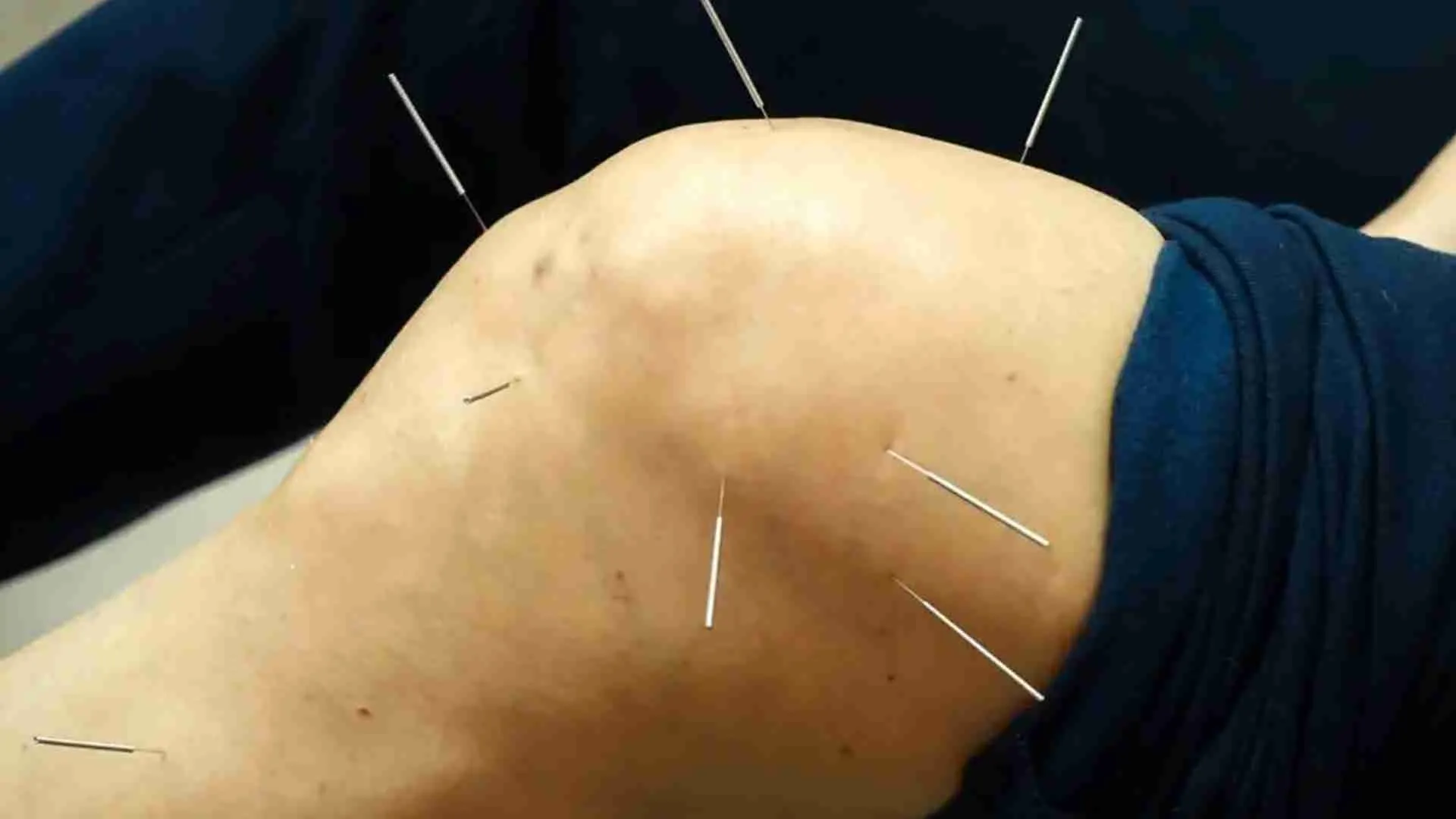 Knee Accupanture Hip knee arthritis