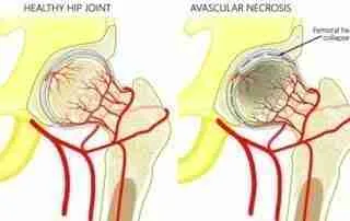 ภาวะเนื้อตายจากการขาดเลือด 10 1 37