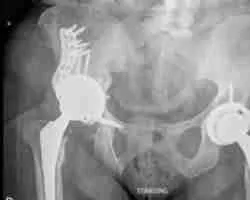 Revision Hip Replacement
