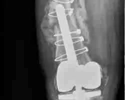 Revision Total Knee Replacement