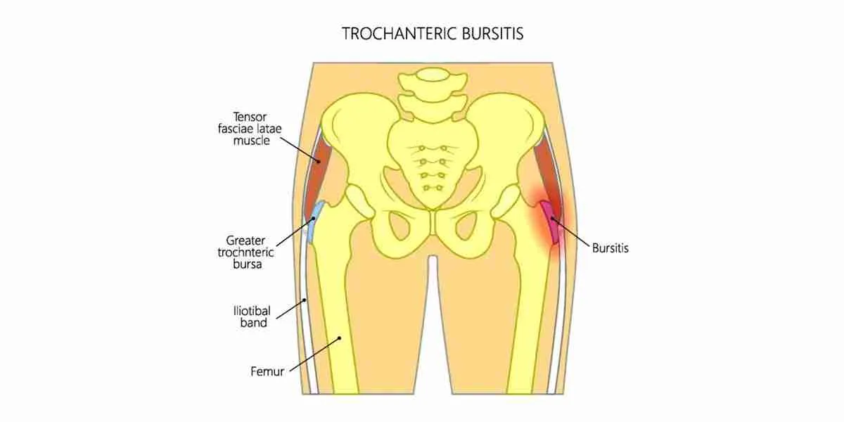 Differential Diagnosis of Anterior Hip Pain - Soft Tissue