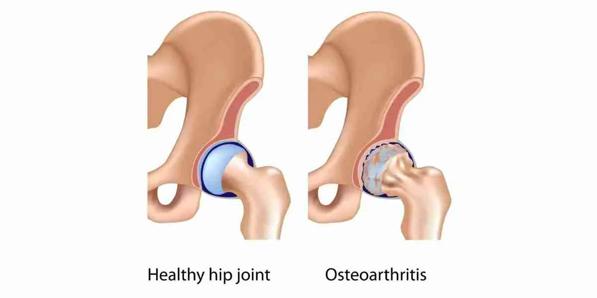 5 Common Causes of Hip Pain and joint pain supplements