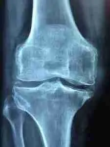 Knee Arthritis