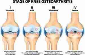 Hip knee arthritis