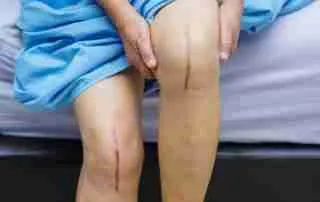 การเปลี่ยนข้อเข่าเทียมแบบวันเดียว 13 clipboard image 21