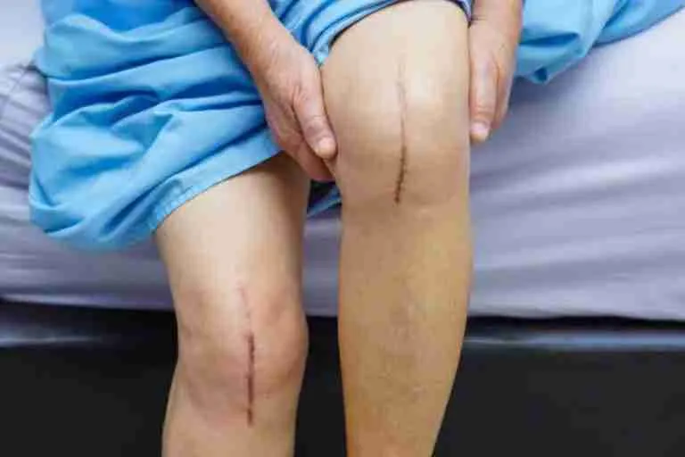 First 3 months after knee replacement surgery First 3 months after knee replacement surgery