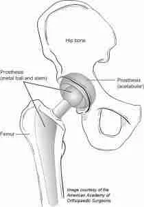 Anterior total hip replacements