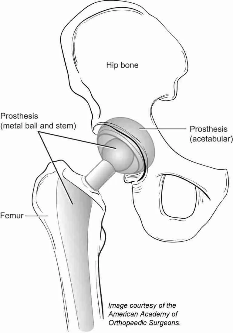 Anterior total hip replacements