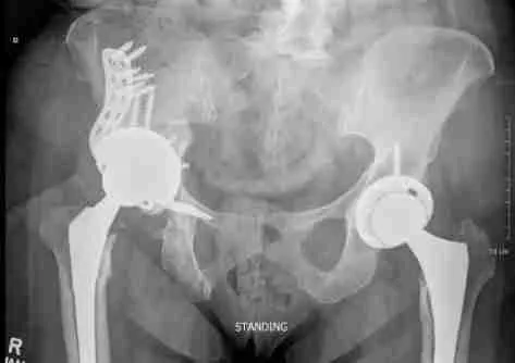 Revision Hip Replacement Surgery Revision Hip Replacement Surgery