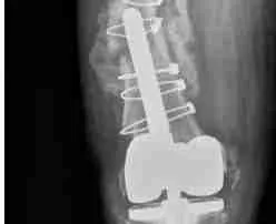 การเปลี่ยนข้อเข่าล้มเหลว 9 clipboard image 43