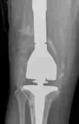 Preparing for Surgery Preparing for Surgery