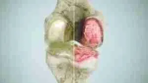 Arthritis Arthritis