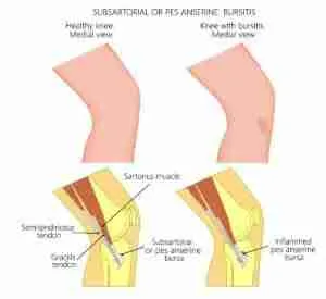 Pes Anserine Bursitis