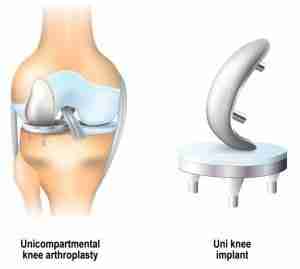 Pacific Bone and Joint - West Oahu 136 Robotic hip knee surgery guide