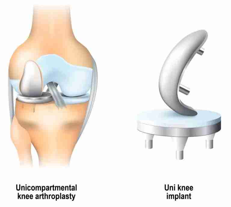 Robotic hip knee surgery guide