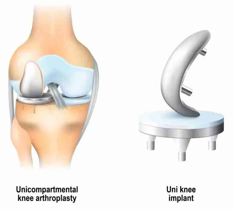 Partial Knee Replacement Robotic hip knee surgery guide