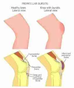 Prepatellar Bursitis Prepatellar Bursitis