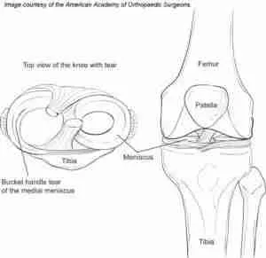 Meniscus Tear