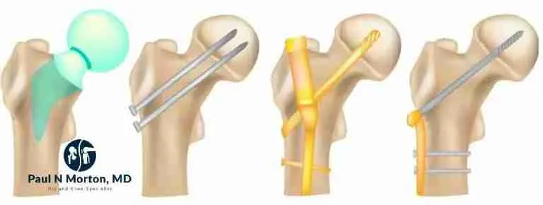 Hip Fractures Hip Fractures
