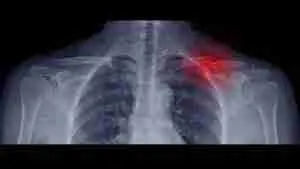 Broken Collarbone (Clavicle) 18 Clavicle fractures