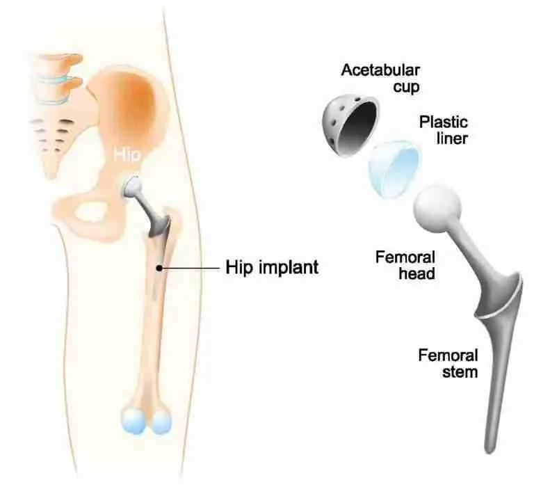 Robotic hip knee surgery guide