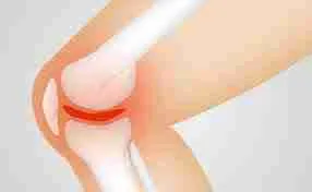 Meniscus tears Meniscus tears