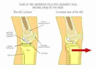 Anterior Cruciate Ligament (ACL) Reconstruction Treatment Hawaii Anterior Cruciate Ligament (ACL) Reconstruction Treatment Hawaii