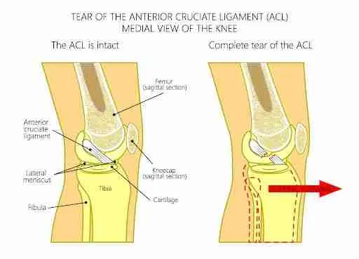The Anterior Cruciate Ligament The Anterior Cruciate Ligament