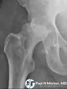 Avn Avascular necrosis of the hip