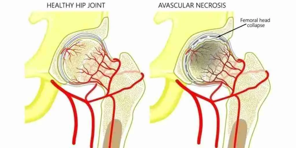 avascular necrosis pathophysiology