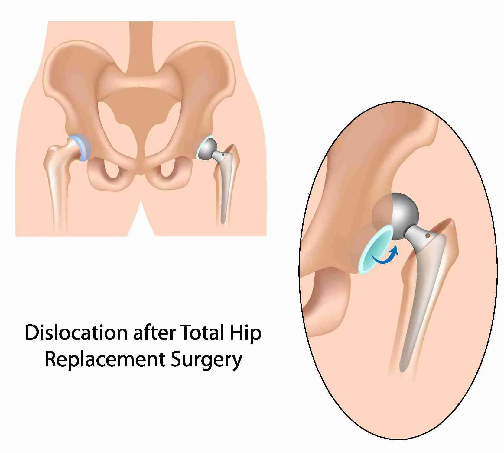 total hip dislocation