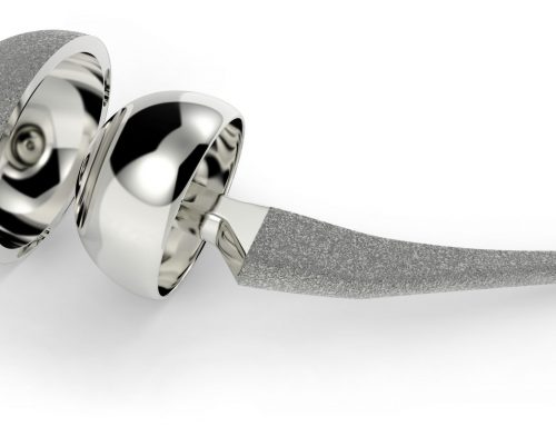 Reemplazo de Cadera Doloroso – 10 Causas de Dolor Continuo