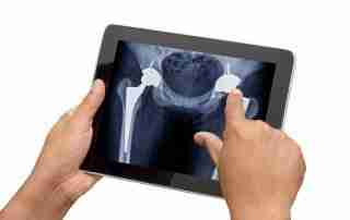 Total Hip Replacement