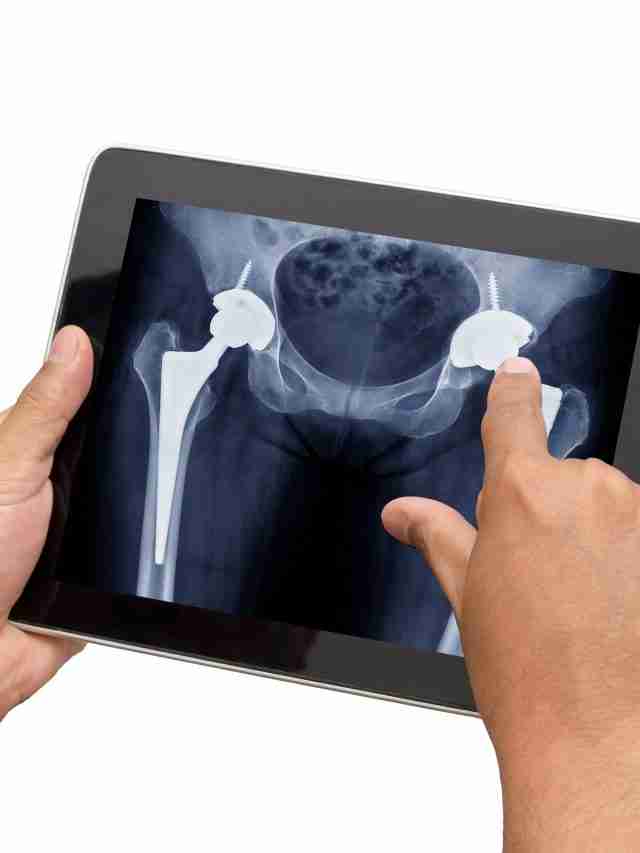 First Year of Recovery after Hip Replacement