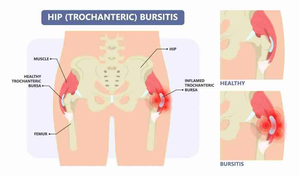 Hip Pain, Hip Injury, Hip Replacement Surgery