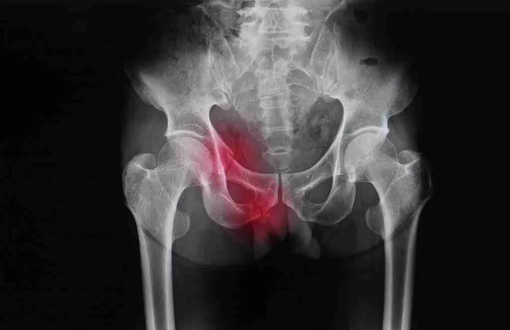 Pelvis,X-ray,Of,A,Patient,Showing,Superior,And,Inferior,Pubic pubic rami fractures