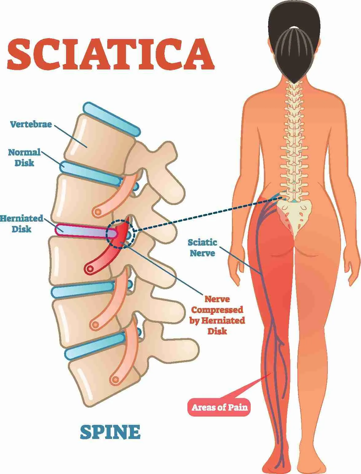 sciatica sciatica