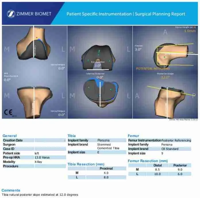 Preop Plan for Rosa Total Knee Arthroplasty